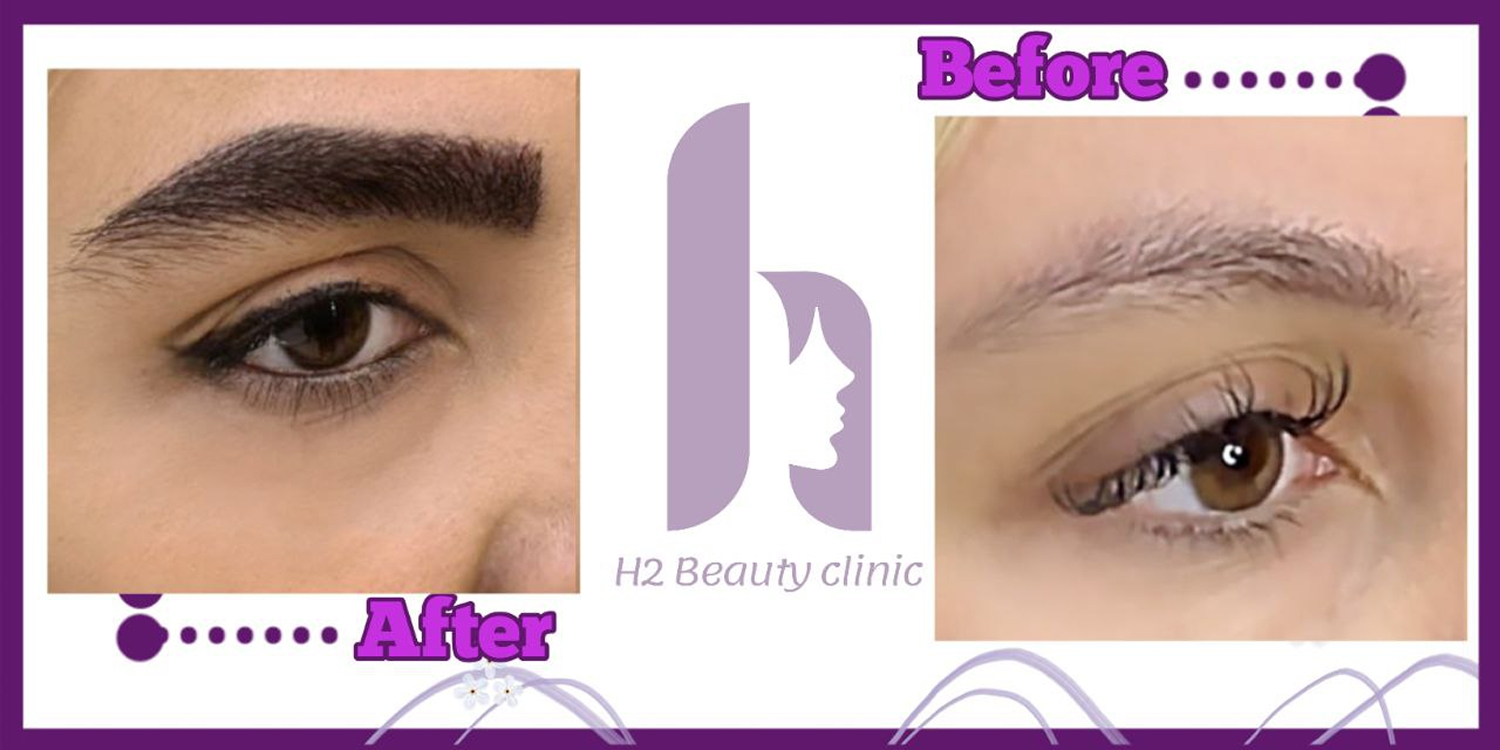 Eyebrow transplant composite photograph, case H2-Eyebrow-2, source: Clinic H2