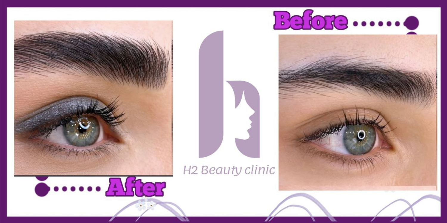 Eyebrow transplant composite photograph, case H2-Eyebrow-3, source: Clinic H2