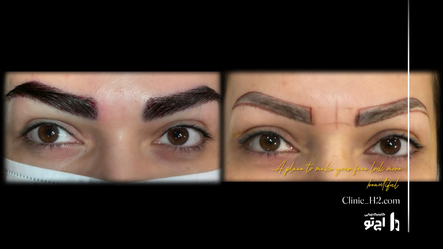 Eyebrow transplant composite photograph, case H2-Eyebrow-4, source: Clinic H2