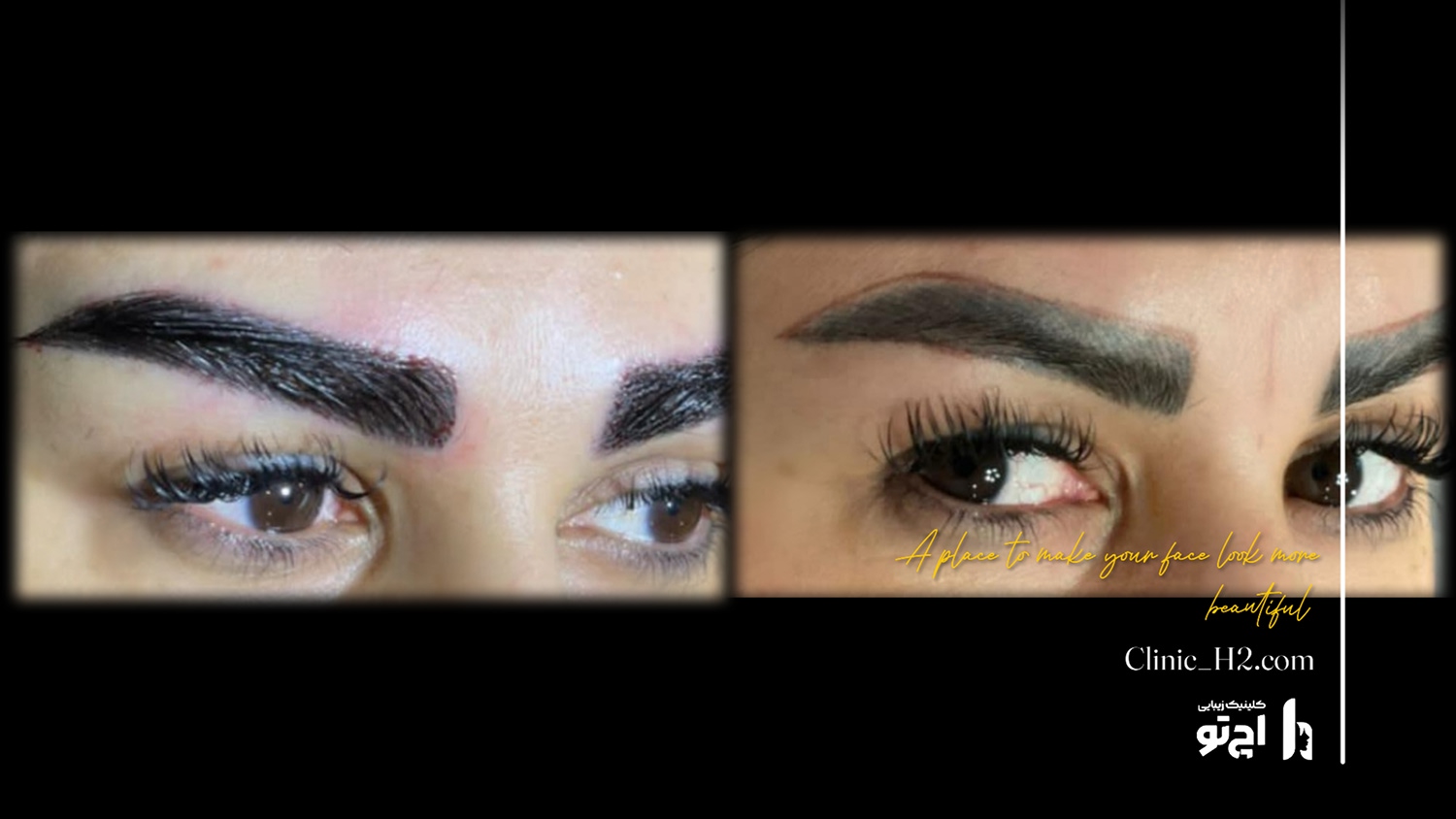 Eyebrow transplant composite photograph, case H2-Eyebrow-5, source: Clinic H2