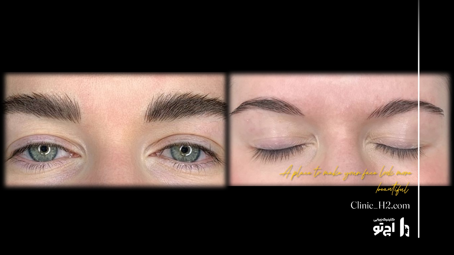 Eyebrow transplant composite photograph, case H2-Eyebrow-6, source: Clinic H2