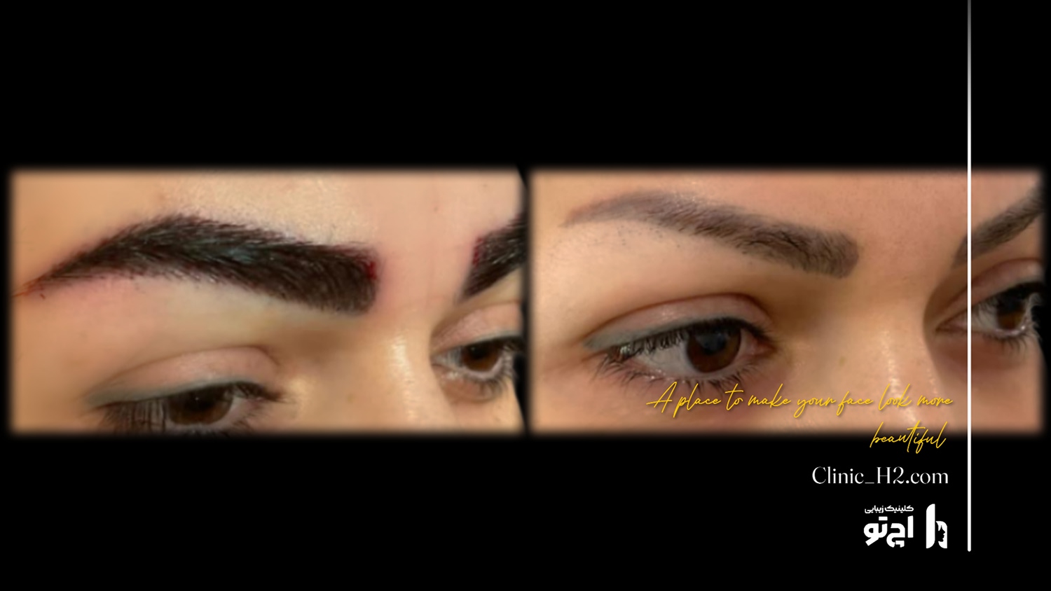 Eyebrow transplant composite photograph, case H2-Eyebrow-7, source: Clinic H2