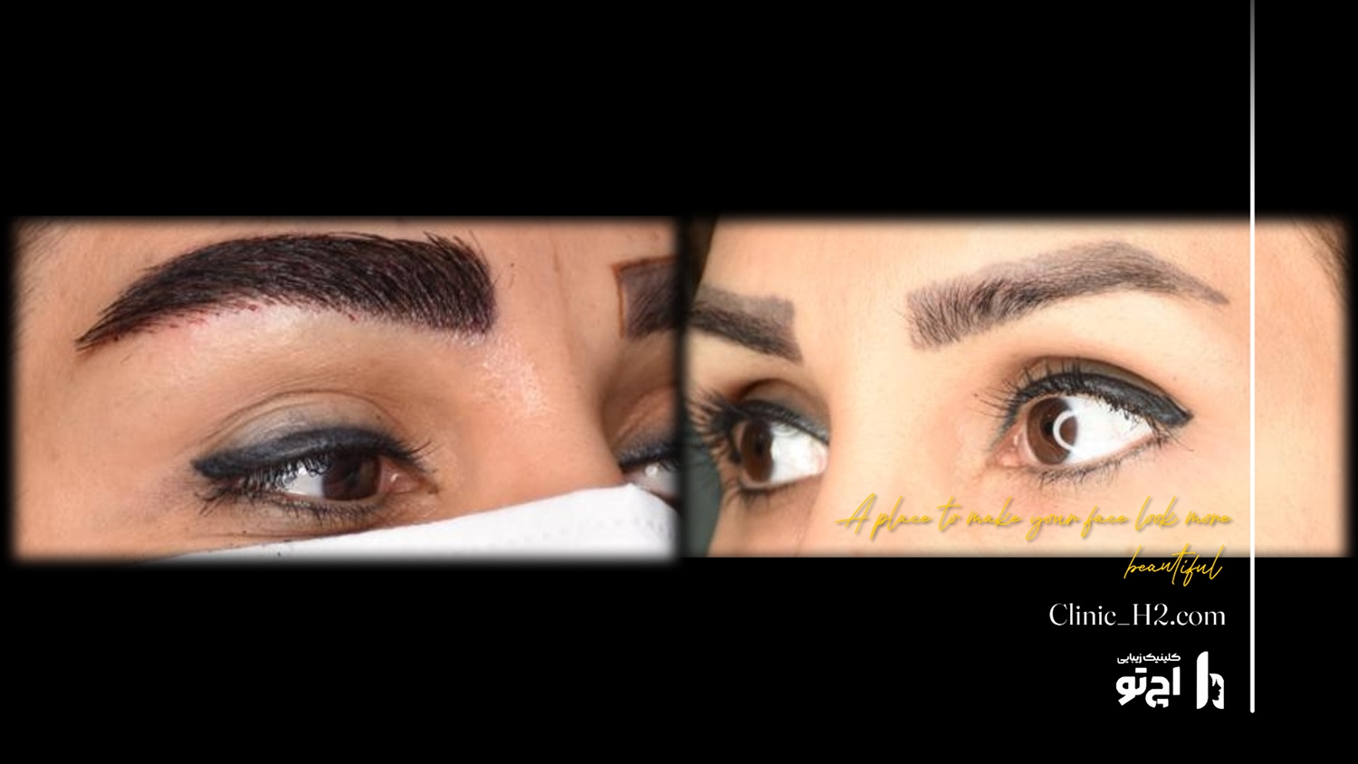 Eyebrow transplant composite photograph, case H2-Eyebrow-8, source: Clinic H2
