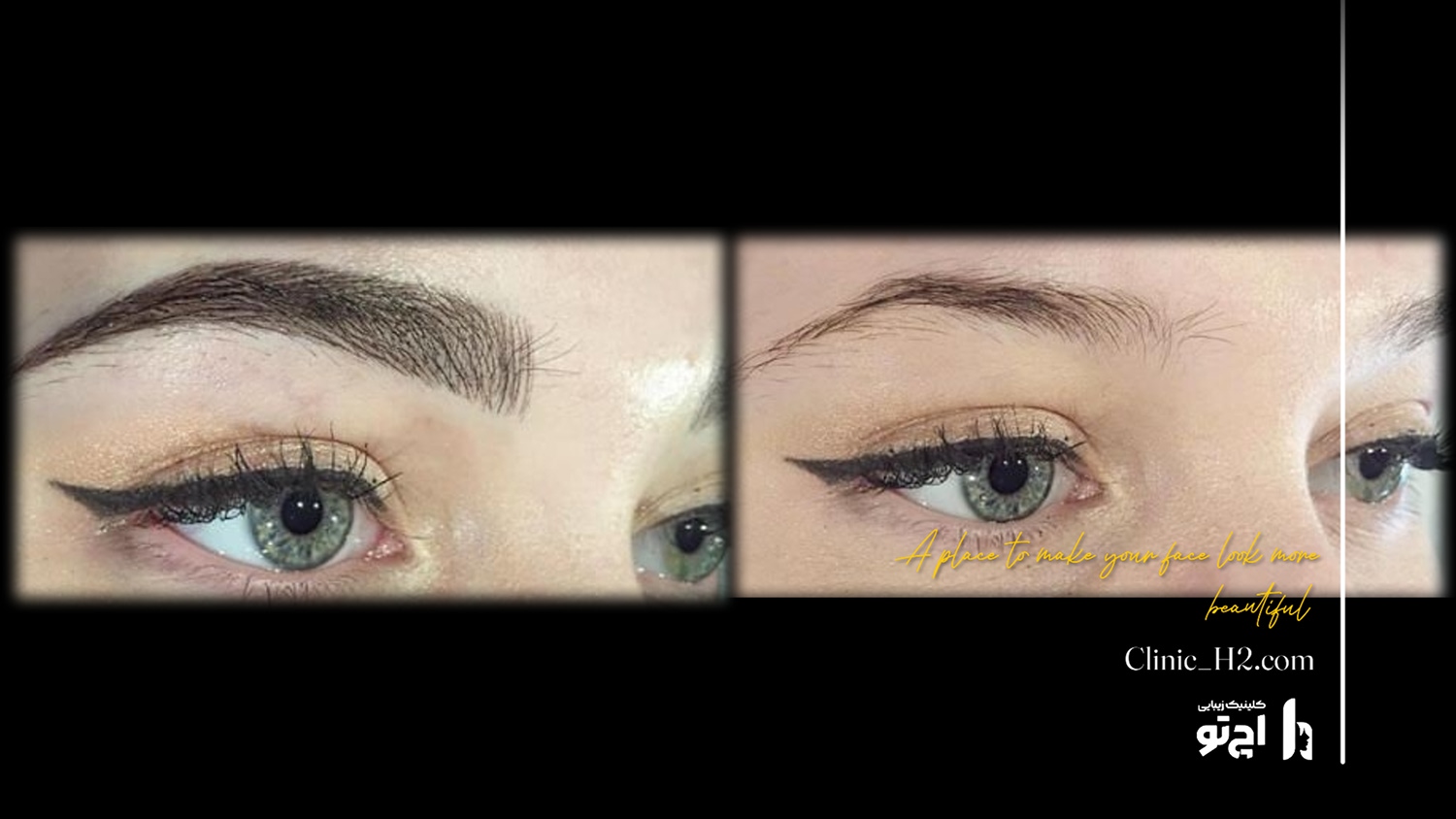 Eyebrow transplant composite photograph, case H2-Eyebrow-9, source: Clinic H2