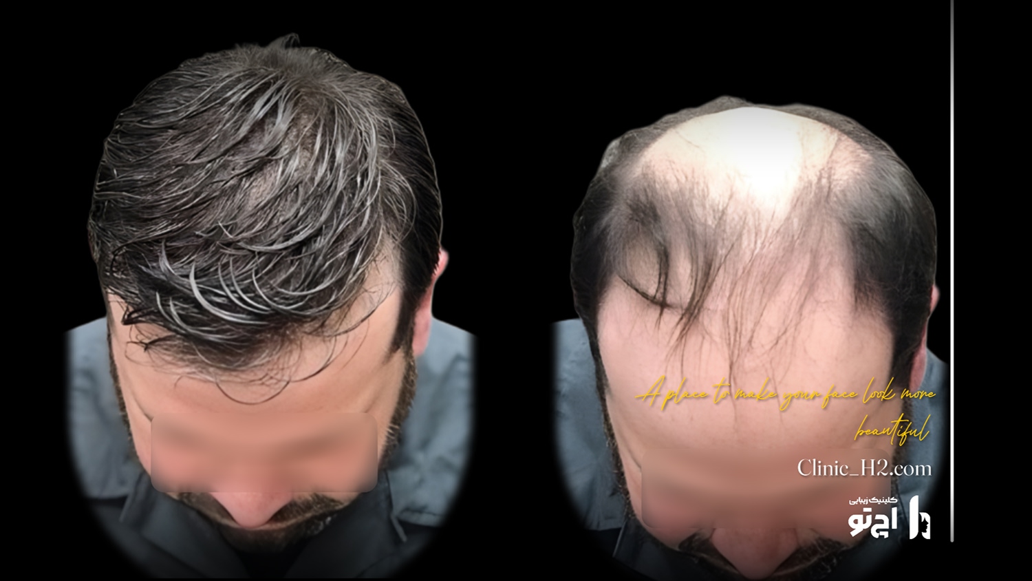 Scalp transplant composite photograph, case H2-Scalp-2, source: Clinic H2