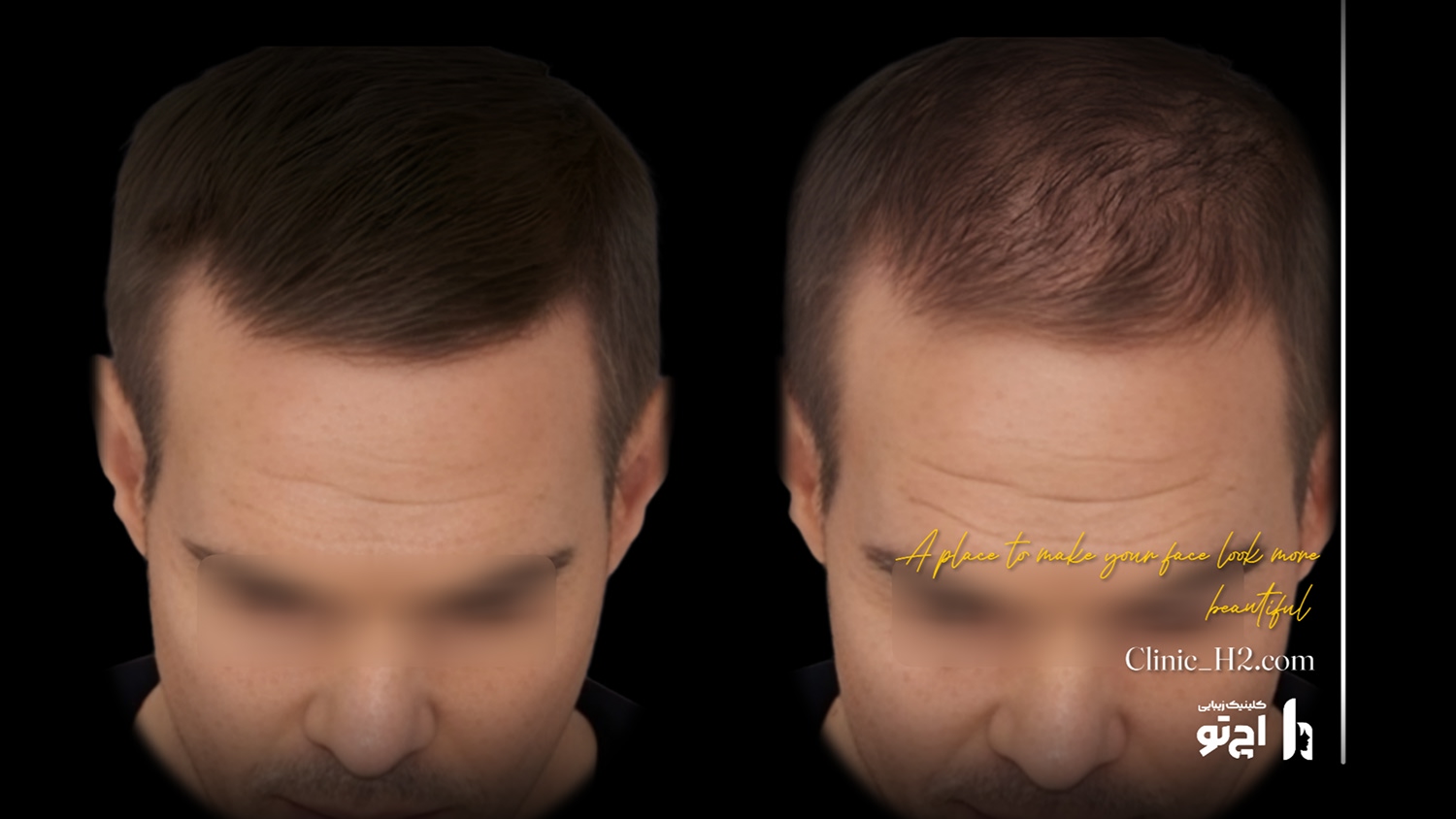 Scalp transplant composite photograph, case H2-Scalp-6, source: Clinic H2