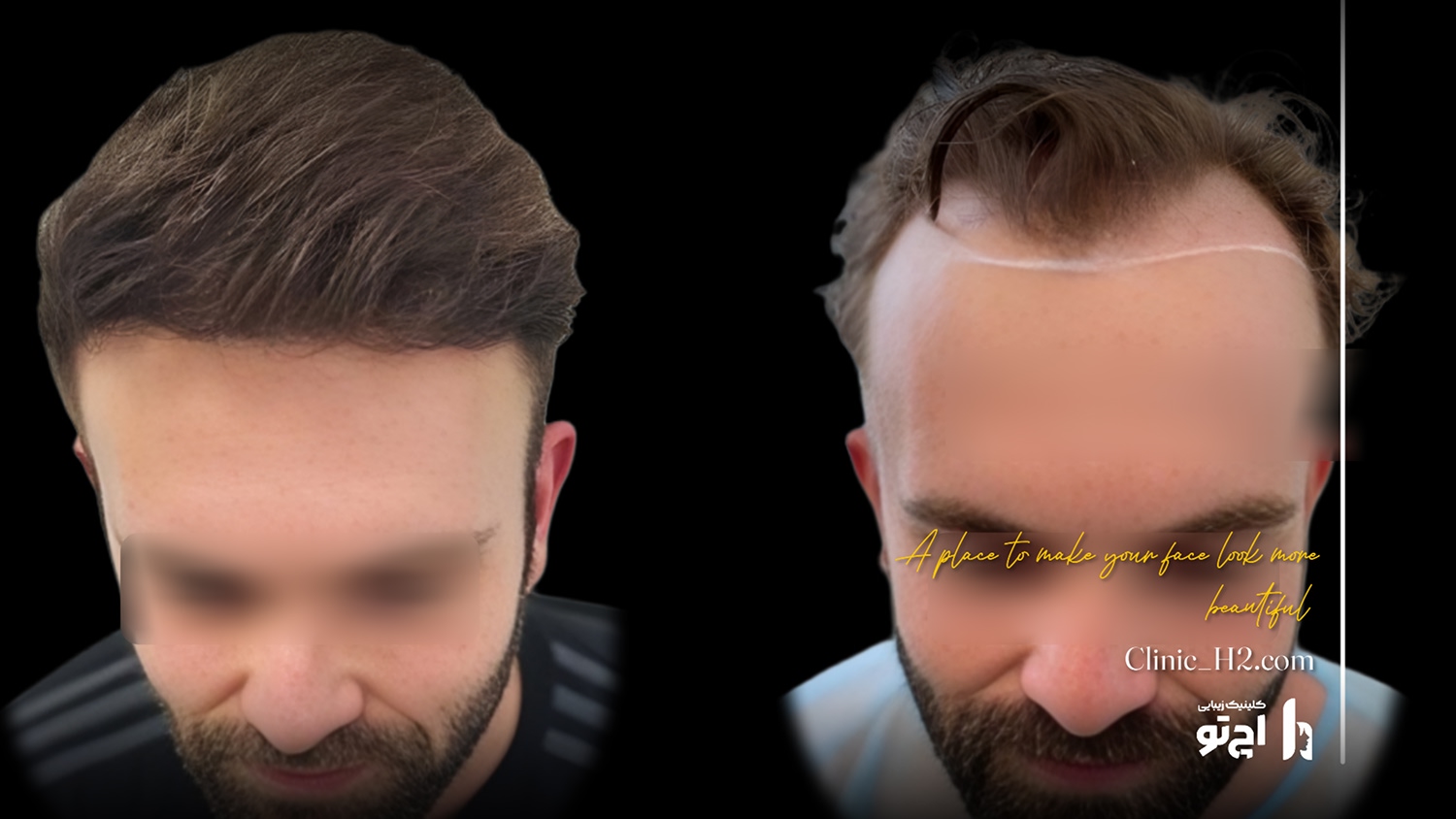Scalp transplant composite photograph, case H2-Scalp-7, source: Clinic H2