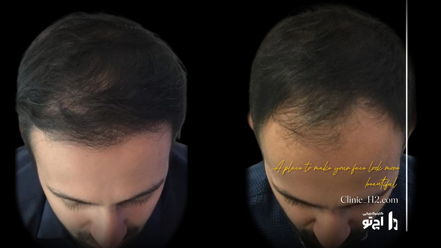Scalp transplant composite photograph, case H2-Scalp-8, source: Clinic H2