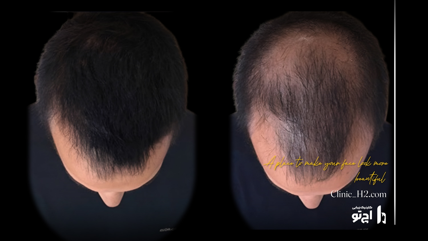 Scalp transplant composite photograph, case H2-Scalp-9, source: Clinic H2