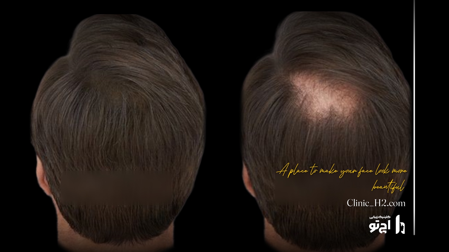 Scalp transplant composite photograph, case H2-Scalp-10, source: Clinic H2