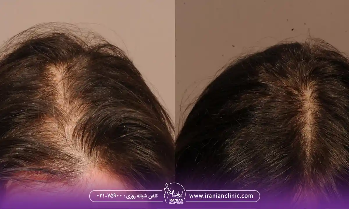 Women’s scalp transplant composite photograph, case IC-W1, source: Iranian Clinic