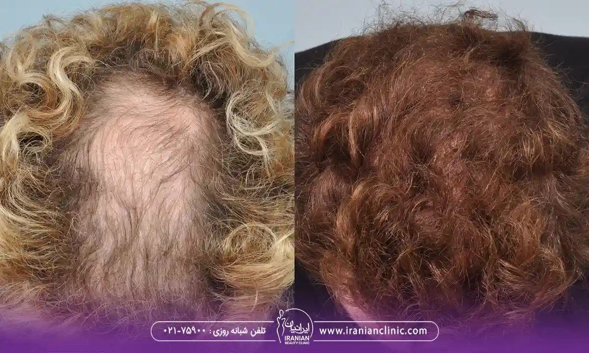 Women’s scalp transplant composite photograph, case IC-W2, source: Iranian Clinic