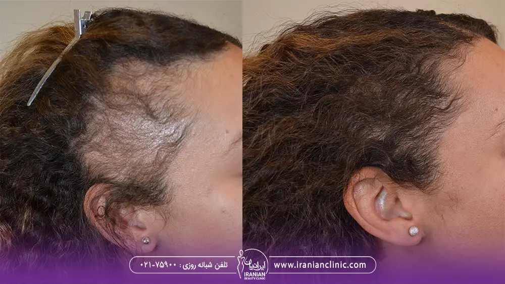 Women’s scalp transplant composite photograph, case IC-W3, source: Iranian Clinic