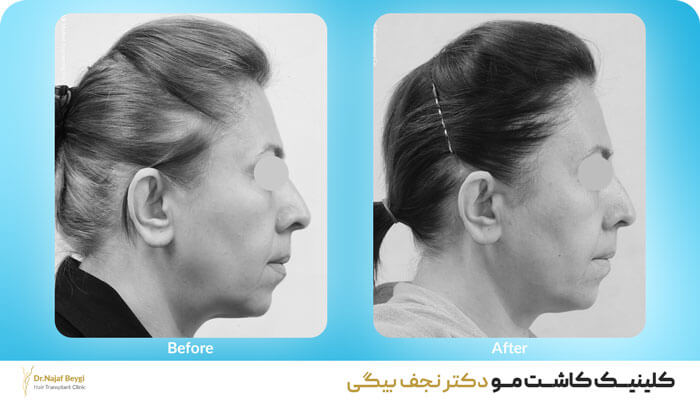 Women’s scalp transplant composite photograph, case DN-W1, source: Dr. Najafbeigi Clinic
