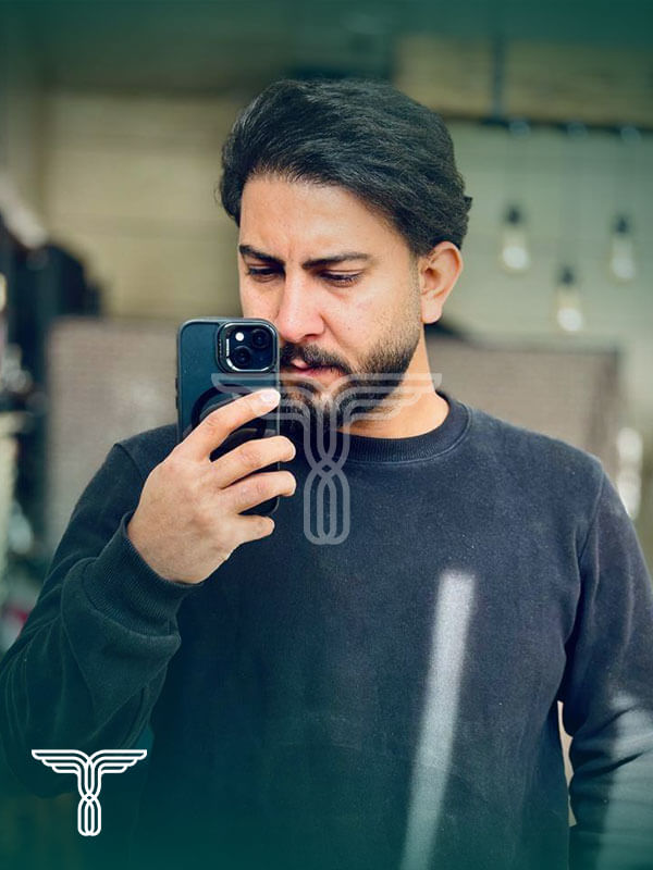 Scalp transplant after photograph, case TK-2, source: Tehran Kasht