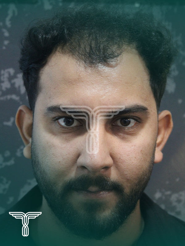 Scalp transplant before photograph, case TK-2, source: Tehran Kasht