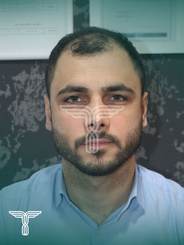 Scalp transplant before photograph, case TK-3, source: Tehran Kasht