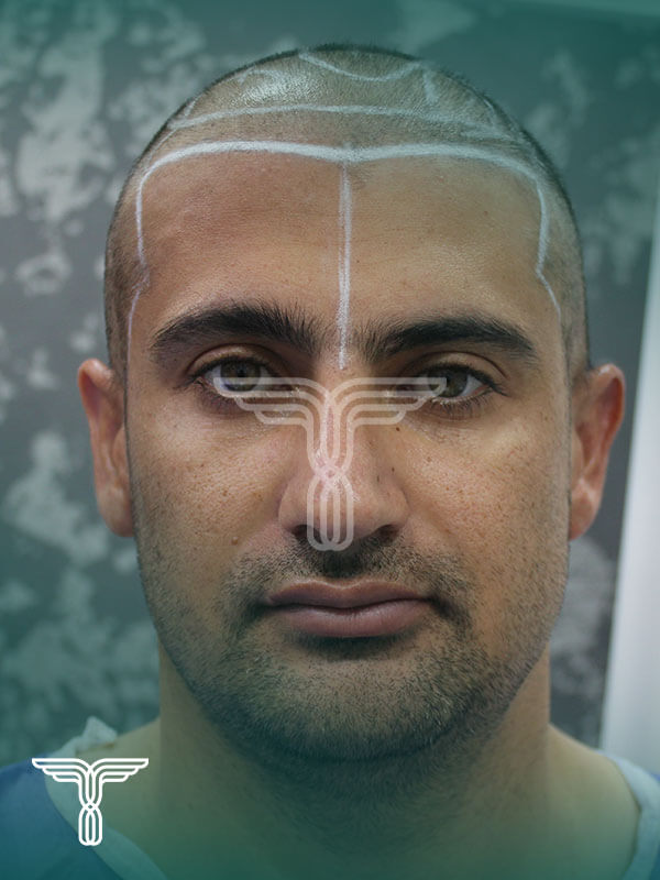 Scalp transplant before photograph, case TK-4, source: Tehran Kasht