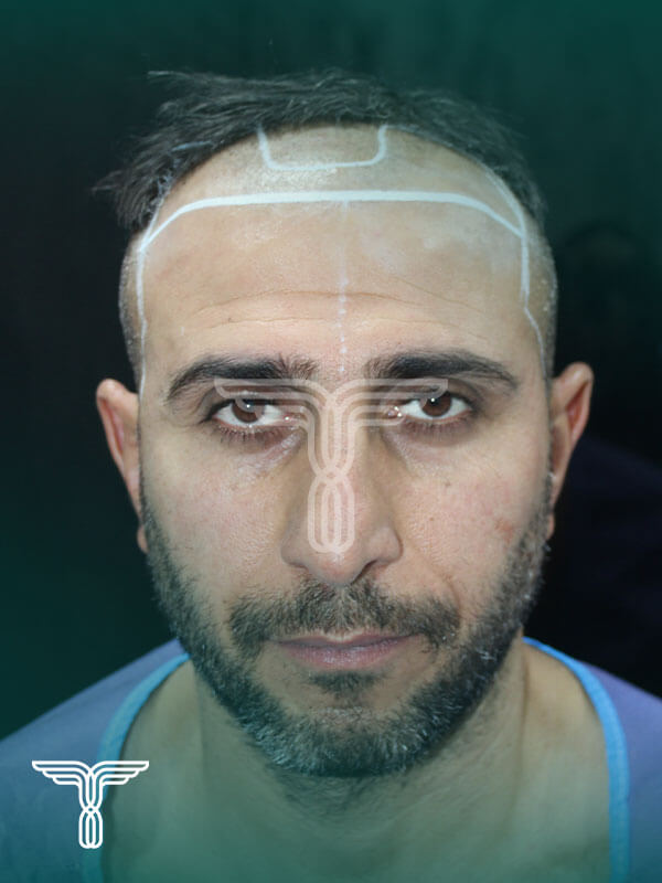 Scalp transplant before photograph, case TK-5, source: Tehran Kasht
