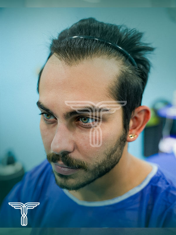 Scalp transplant before photograph, case TK-6, source: Tehran Kasht