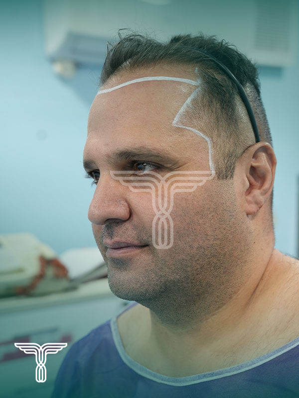 Scalp transplant before photograph, case TK-7, source: Tehran Kasht