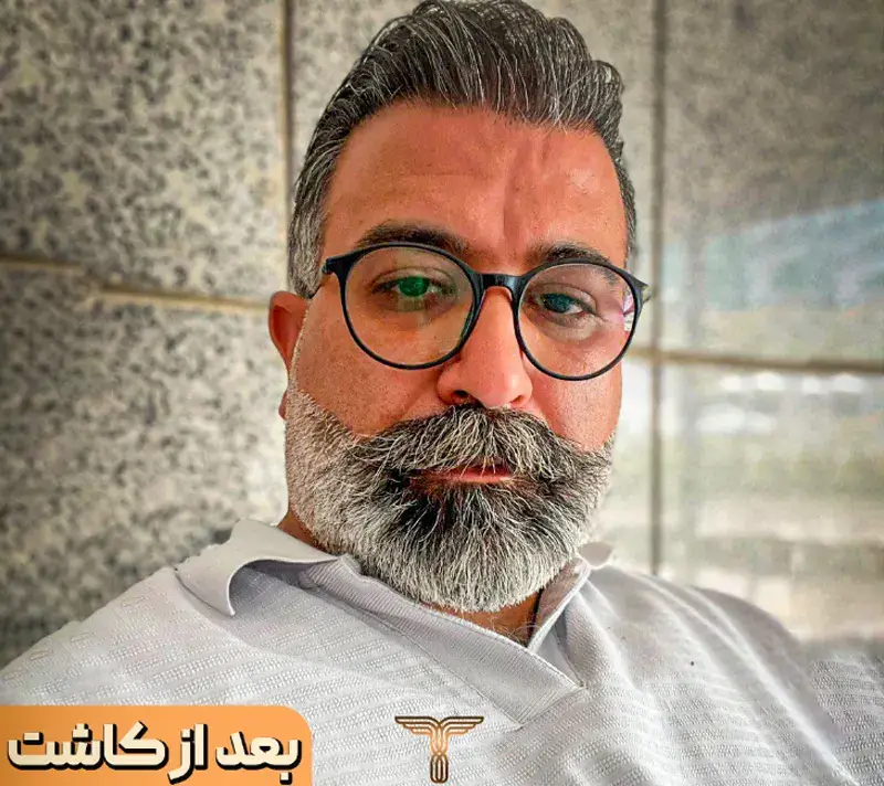 Scalp transplant after photograph, case TK-9, source: Tehran Kasht