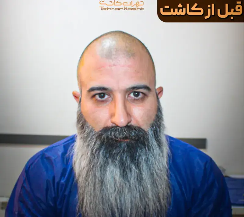 Scalp transplant before photograph, case TK-9, source: Tehran Kasht