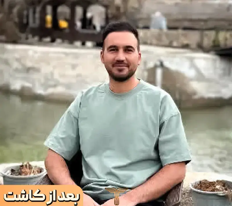 Scalp transplant after photograph, case TK-10, source: Tehran Kasht