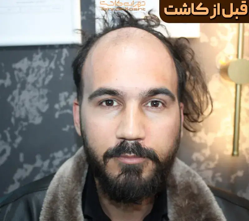 Scalp transplant before photograph, case TK-10, source: Tehran Kasht