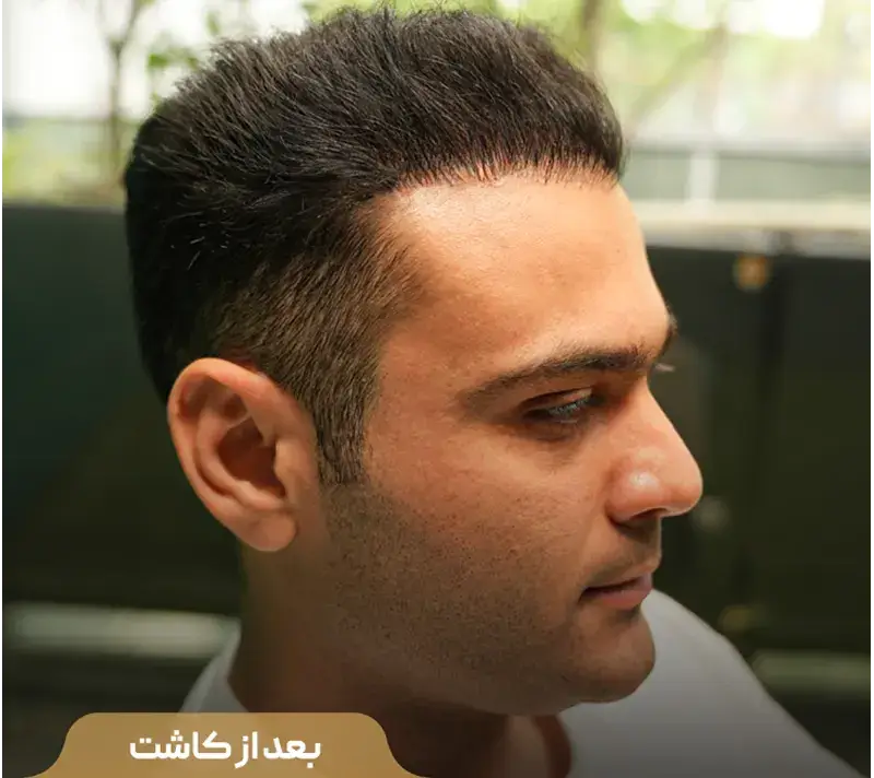 Scalp transplant after photograph, case TK-11, source: Tehran Kasht