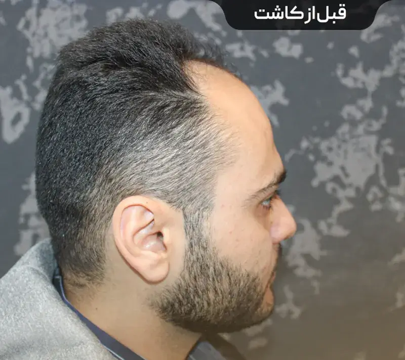 Scalp transplant before photograph, case TK-11, source: Tehran Kasht