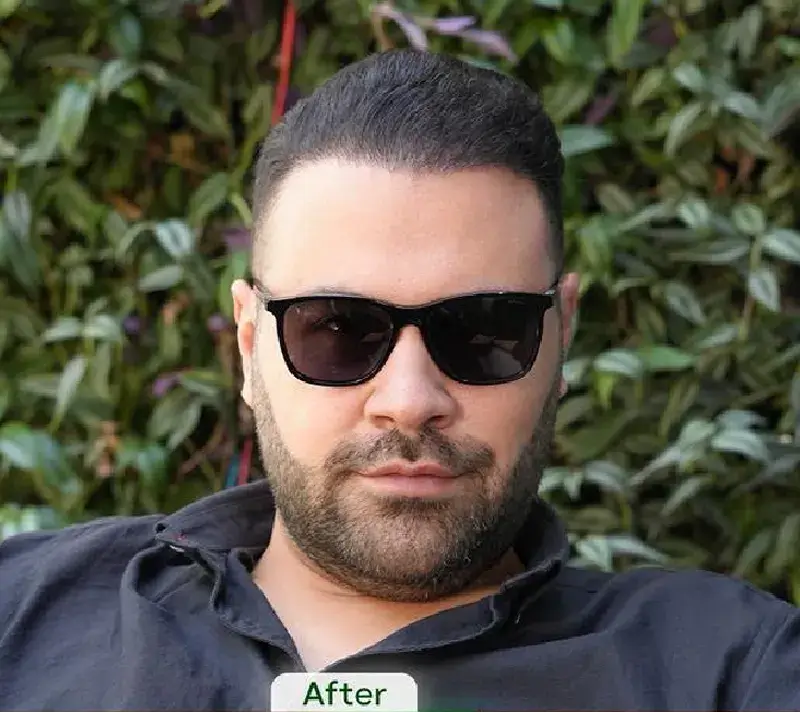 Scalp transplant after photograph, case TK-12, source: Tehran Kasht