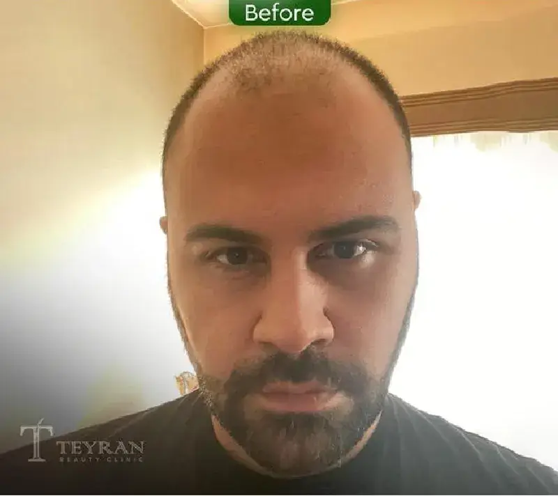 Scalp transplant before photograph, case TK-12, source: Tehran Kasht