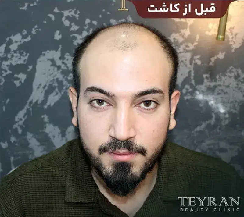 Scalp transplant before photograph, case TK-13, source: Tehran Kasht