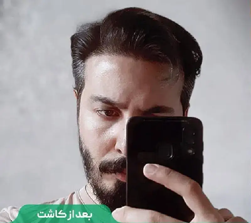 Scalp transplant after photograph, case TK-14, source: Tehran Kasht