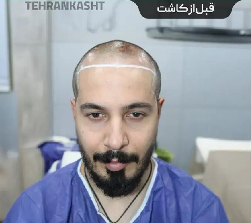 Scalp transplant before photograph, case TK-14, source: Tehran Kasht