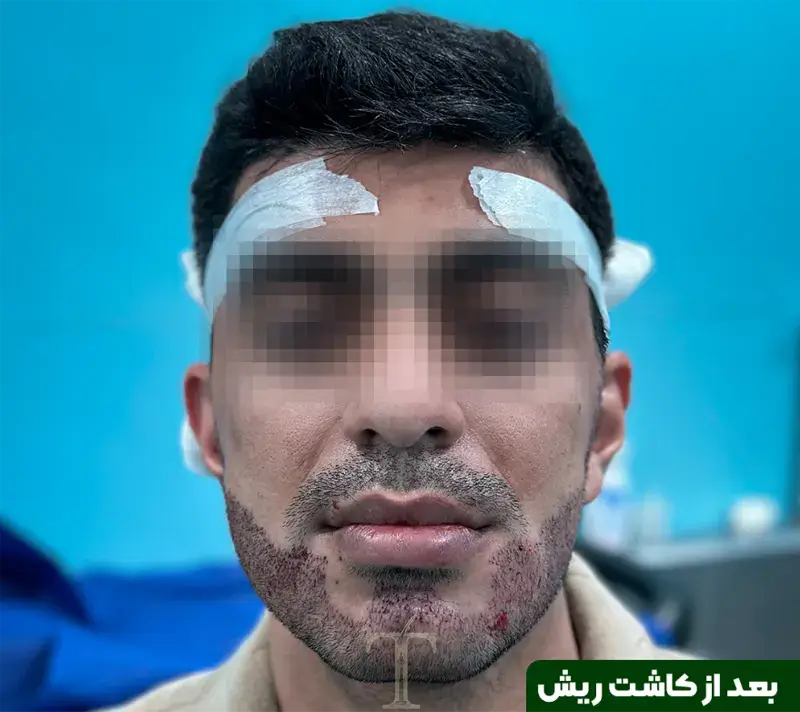 Beard transplant after photograph, case TK-15, source: Tehran Kasht