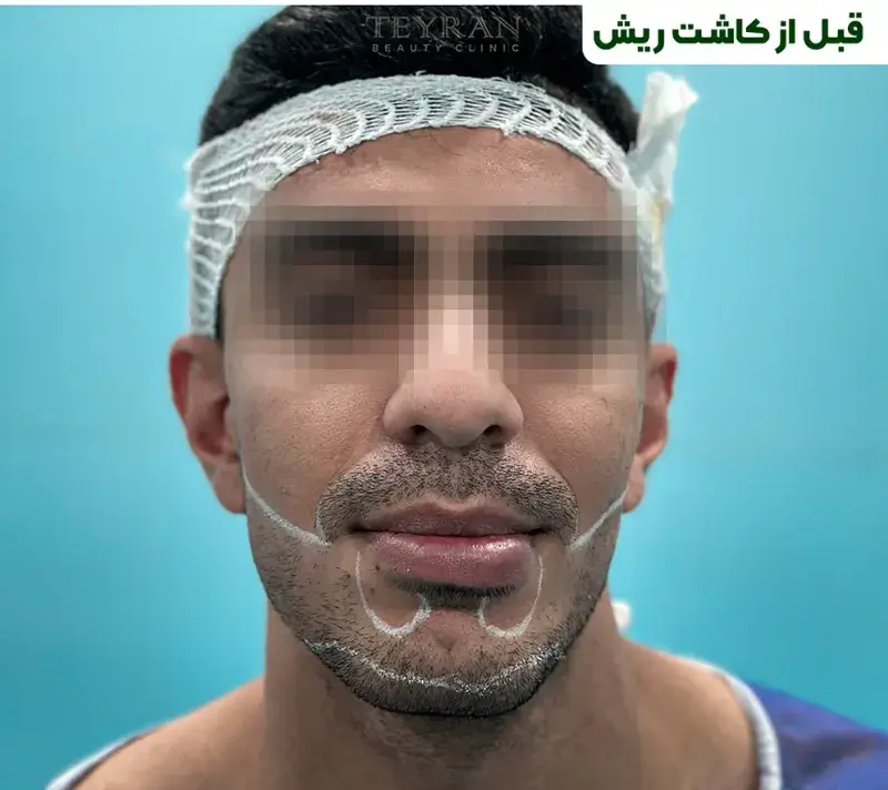 Beard transplant before photograph, case TK-15, source: Tehran Kasht