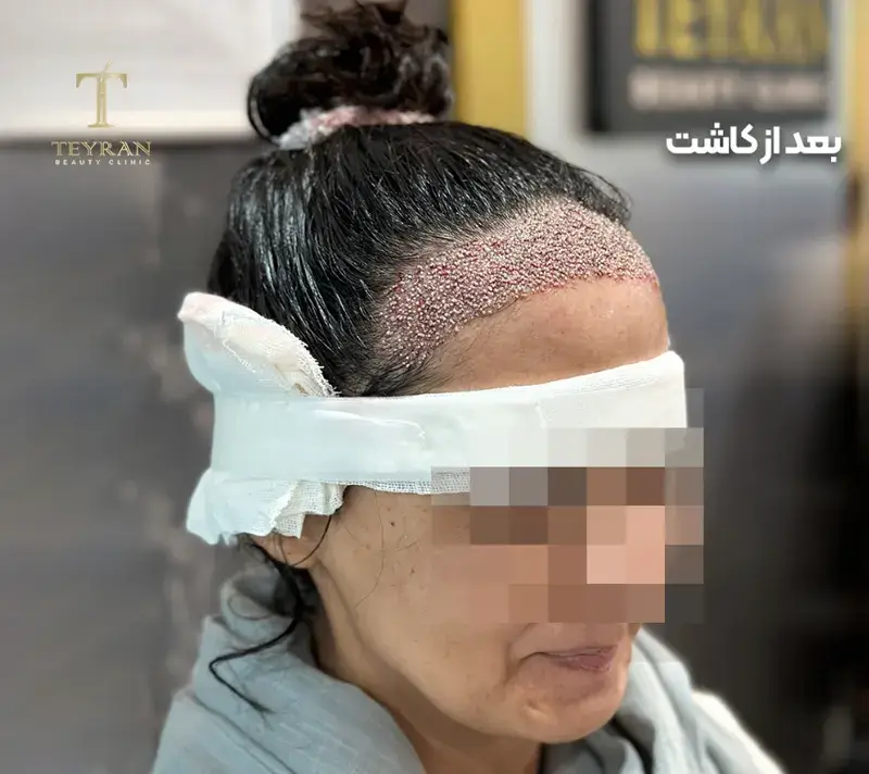 Women’s scalp transplant after photograph, case TK-16, source: Tehran Kasht