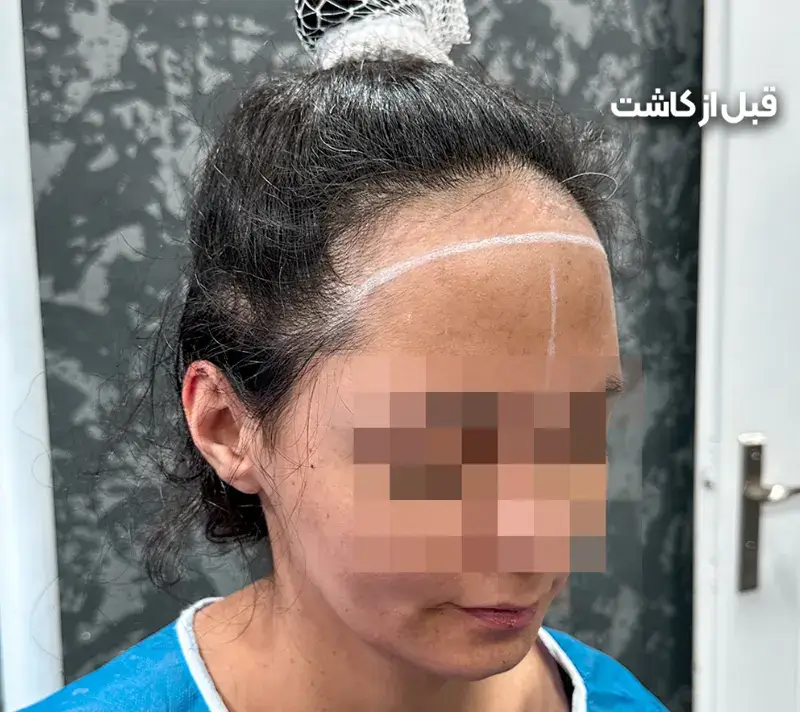 Women’s scalp transplant before photograph, case TK-16, source: Tehran Kasht