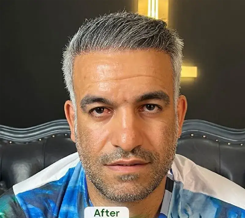 Eyebrow transplant after photograph, case TK-17, source: Tehran Kasht