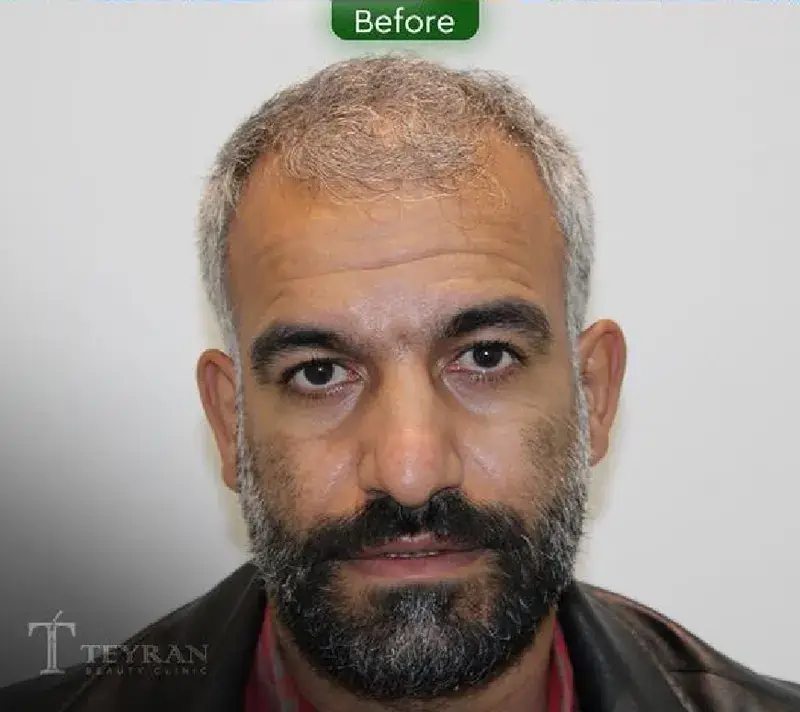 Eyebrow transplant before photograph, case TK-17, source: Tehran Kasht