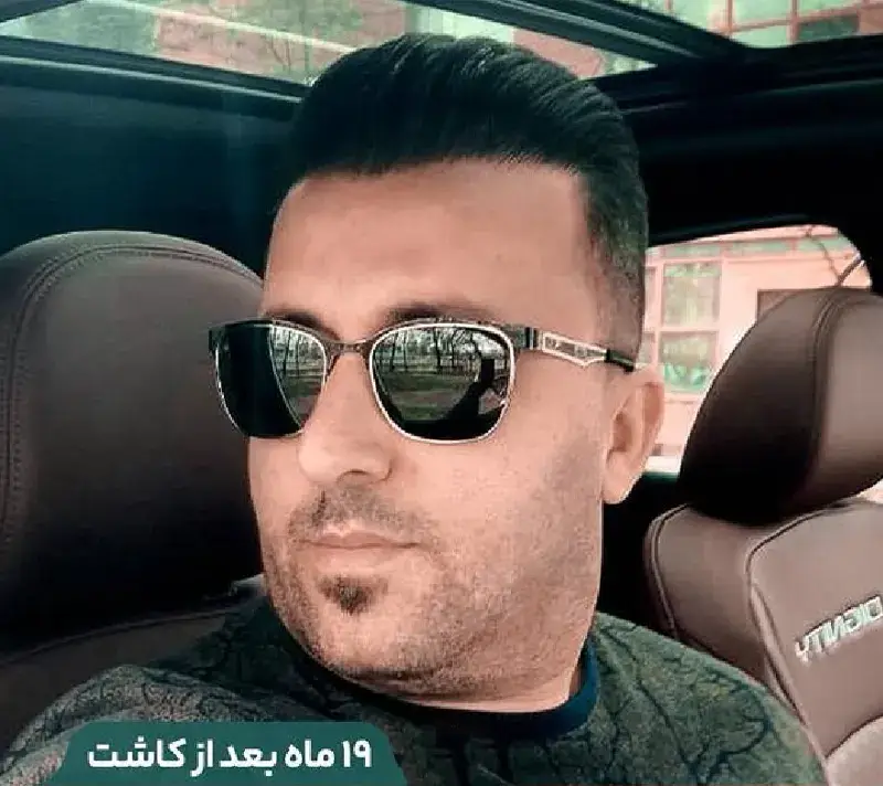 Beard transplant after photograph, case TK-18, source: Tehran Kasht