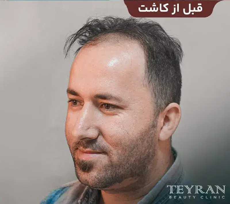 Beard transplant before photograph, case TK-18, source: Tehran Kasht