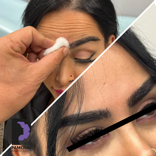 Botulinum toxin results before and after example 1 in Tehran