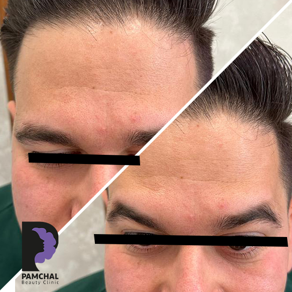 Botulinum toxin results before and after example 2 in Tehran