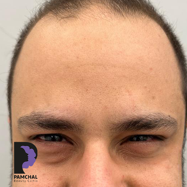 Botulinum toxin results before and after example 6 in Tehran
