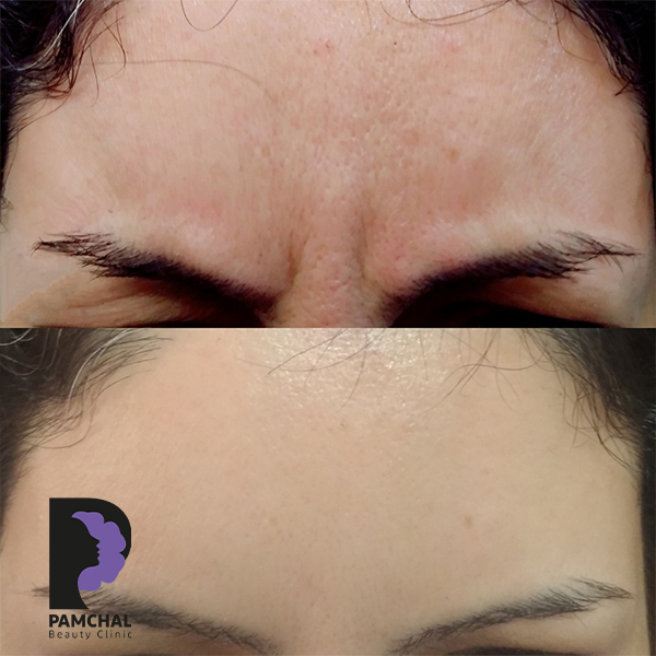 Botulinum toxin results before and after example 9 in Tehran