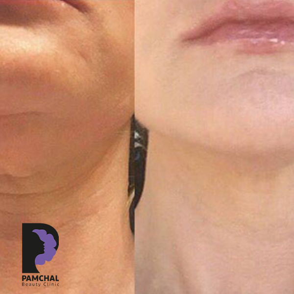 Botulinum toxin results before and after example 10 in Tehran