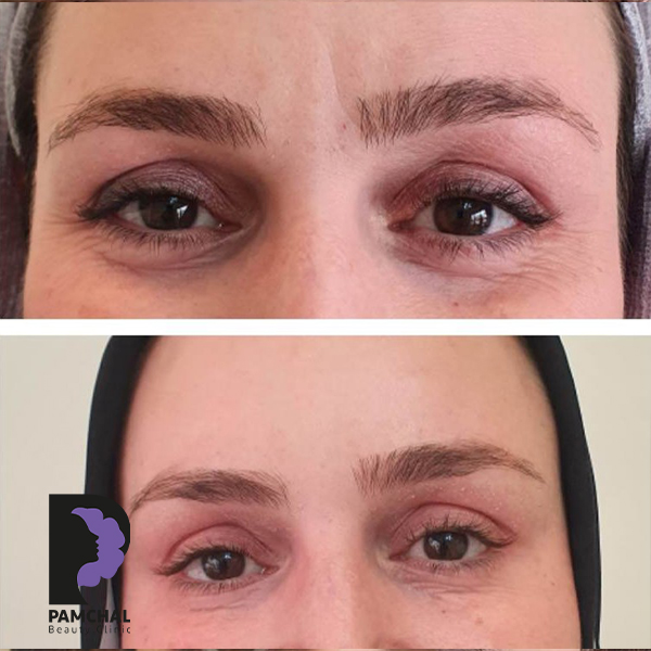 Botulinum toxin results before and after example 12 in Tehran